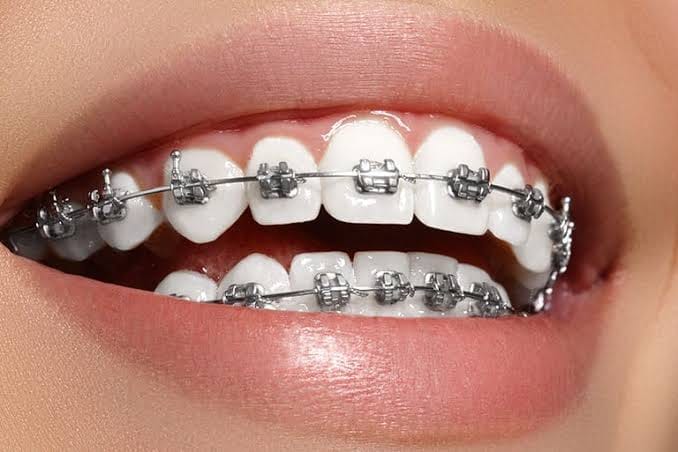 Braces Vadodara